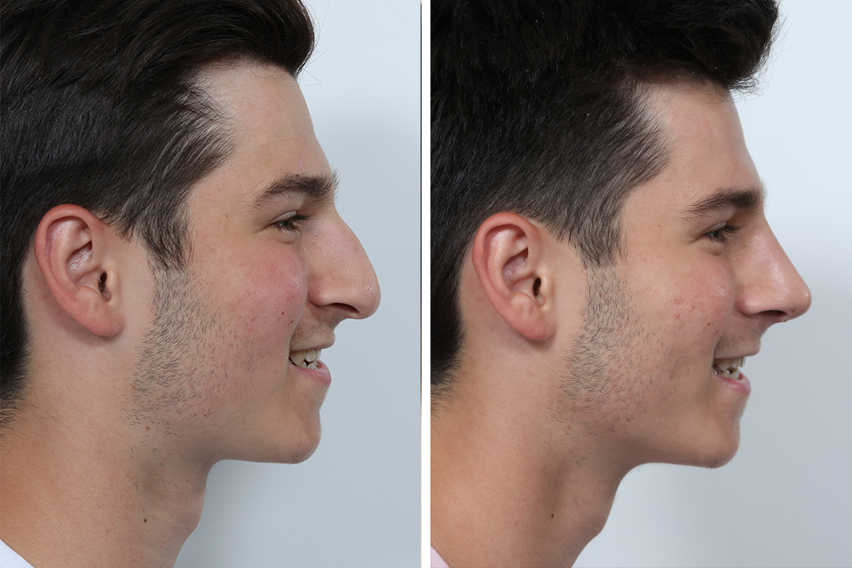 rhinoplasty-men-Rhinoplasty-263