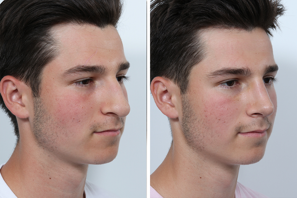 rhinoplasty-men-Rhinoplasty-264