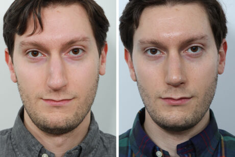 Rhinoplasty case #3519