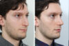 Rhinoplasty case #3519 slider thumbnail