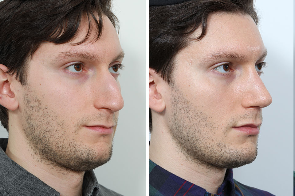 Rhinoplasty case #3519