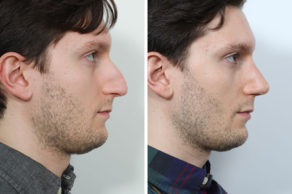 Rhinoplasty case #3519