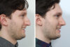 Rhinoplasty case #3519 slider thumbnail