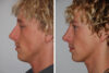 Rhinoplasty case #3529 slider thumbnail