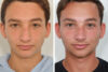 Rhinoplasty case #3513 slider thumbnail