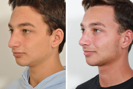 Rhinoplasty case #3513