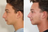 Rhinoplasty case #3513 slider thumbnail