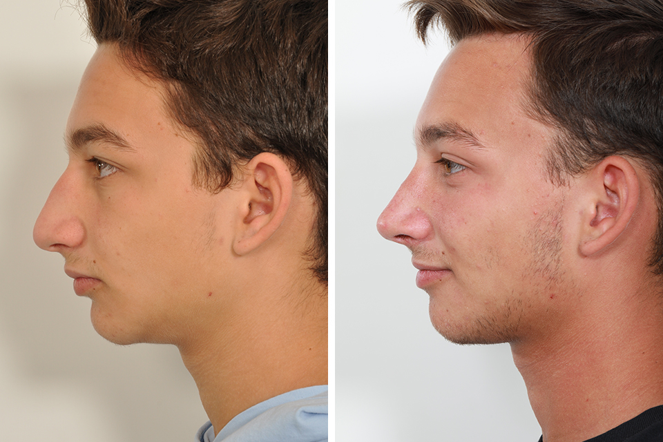 Rhinoplasty case #3513