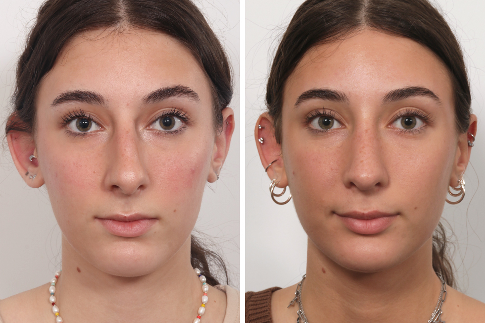 Rhinoplasty case #4546