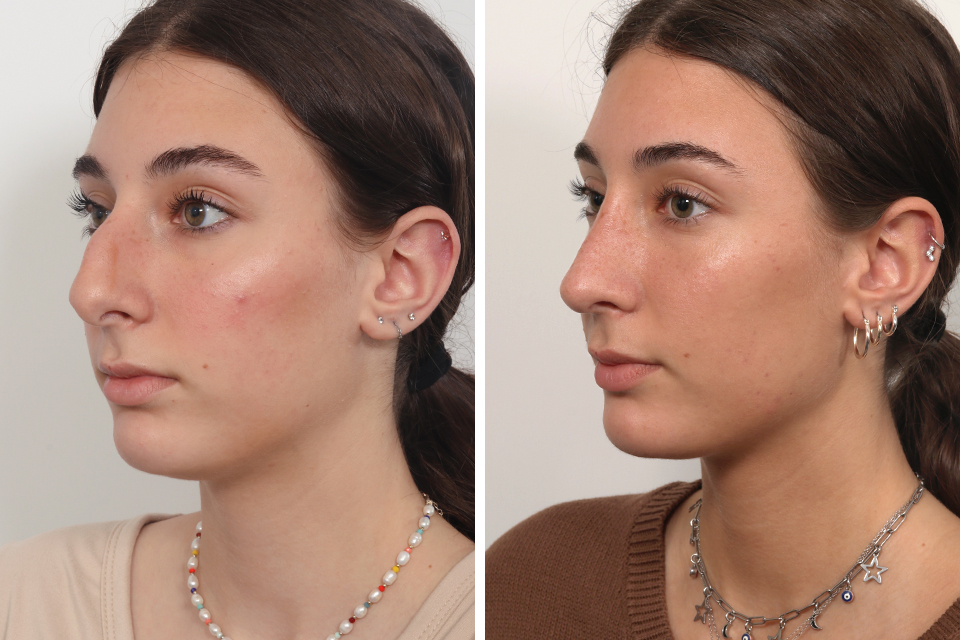 Rhinoplasty case #4546