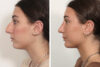 Rhinoplasty case #4546 slider thumbnail