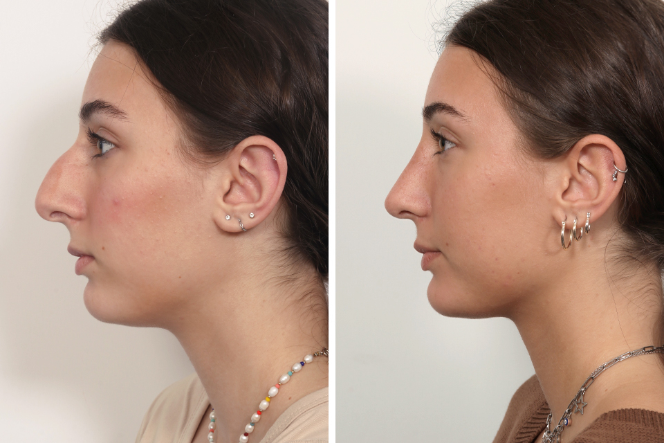 Rhinoplasty case #4546