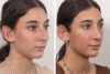 Rhinoplasty case #4546 slider thumbnail