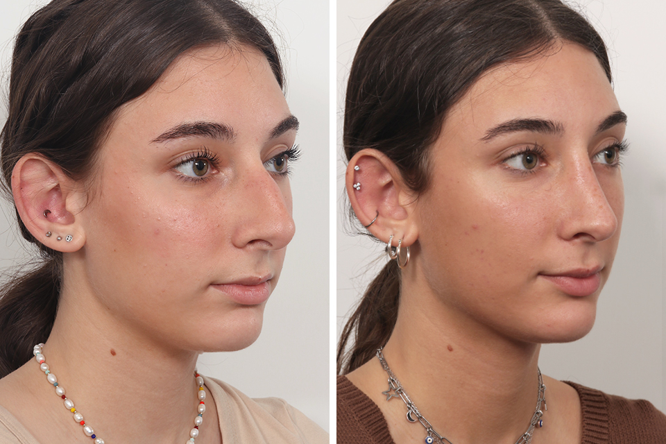 Rhinoplasty case #4546