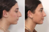 Rhinoplasty case #4546 slider thumbnail