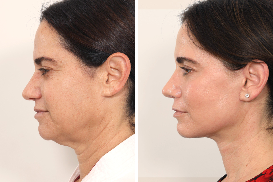 Facelift case #4889