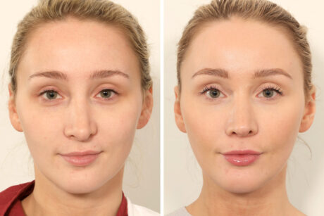 Rhinoplasty case #4835