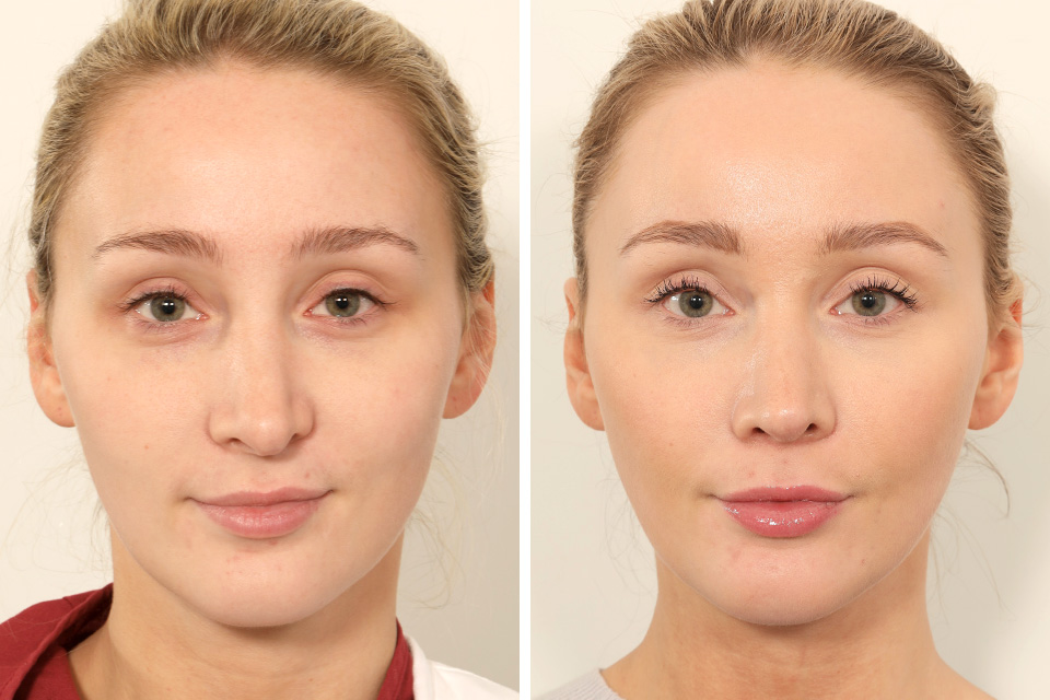 Rhinoplasty case #4835
