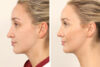 Rhinoplasty case #4835 slider thumbnail