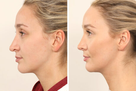 Rhinoplasty case #4835