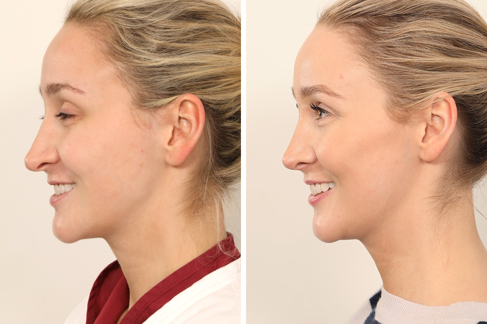Rhinoplasty case #4835
