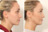 Rhinoplasty case #4835 slider thumbnail