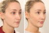 Rhinoplasty case #4835 slider thumbnail
