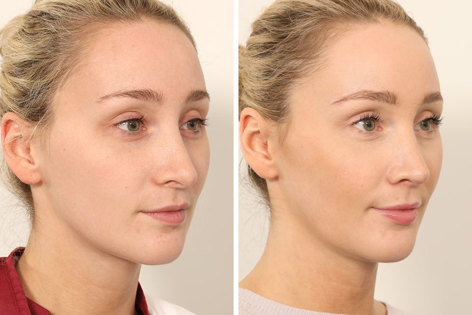 Rhinoplasty case #4835