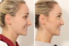 Rhinoplasty case #4835 slider thumbnail