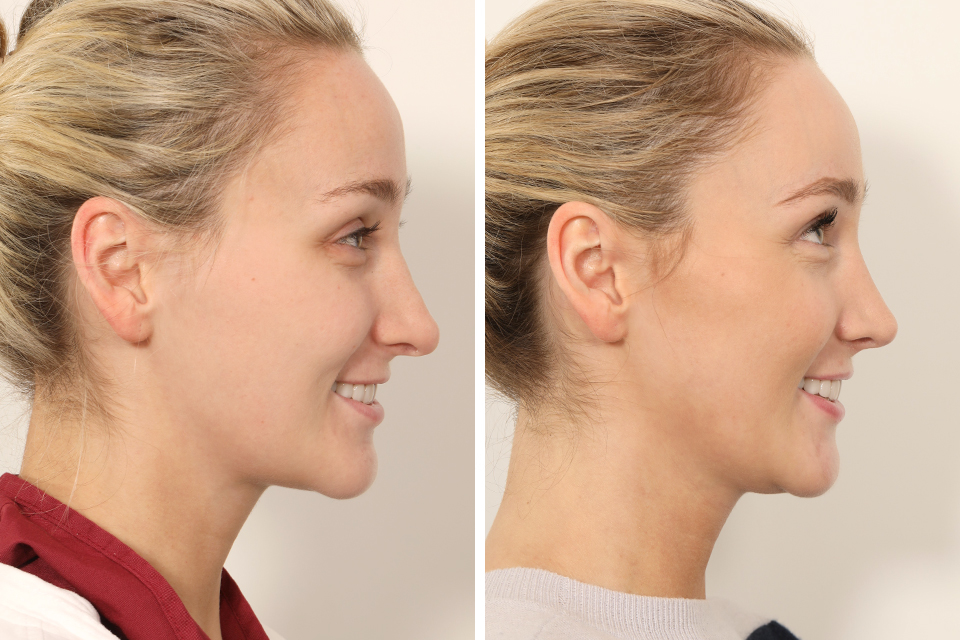Rhinoplasty case #4835