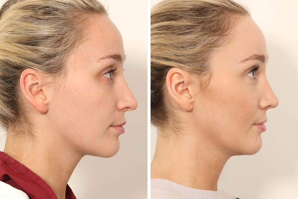 Rhinoplasty case #4835
