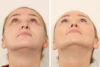 Rhinoplasty case #4835 slider thumbnail