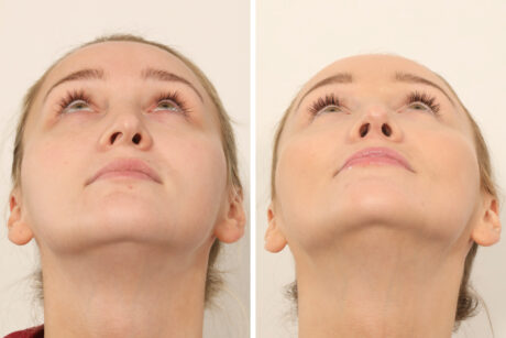 Rhinoplasty case #4835