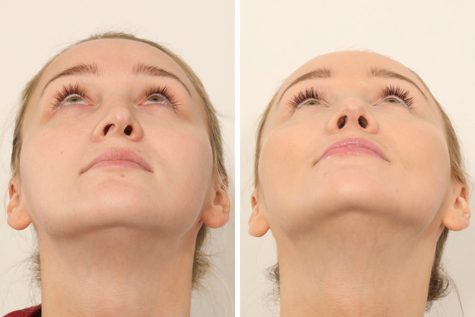 Rhinoplasty case #4835