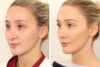 Rhinoplasty case #4835 slider thumbnail
