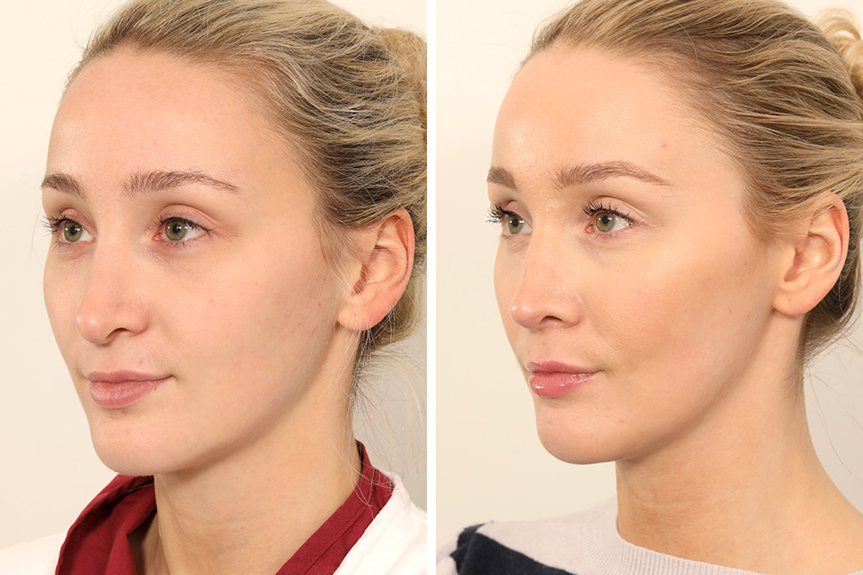 Rhinoplasty case #4835