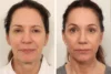Brow Lift case #5191 slider thumbnail