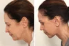 Brow Lift case #5191 slider thumbnail