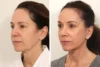Brow Lift case #5191 slider thumbnail
