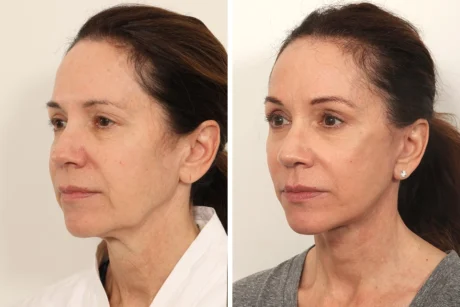 Brow Lift case #5191