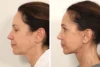 Brow Lift case #5191 slider thumbnail