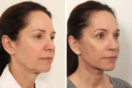Brow Lift case #5191