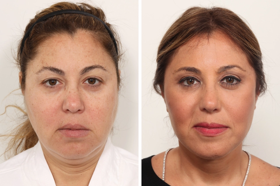 Blepharoplasty case #5634