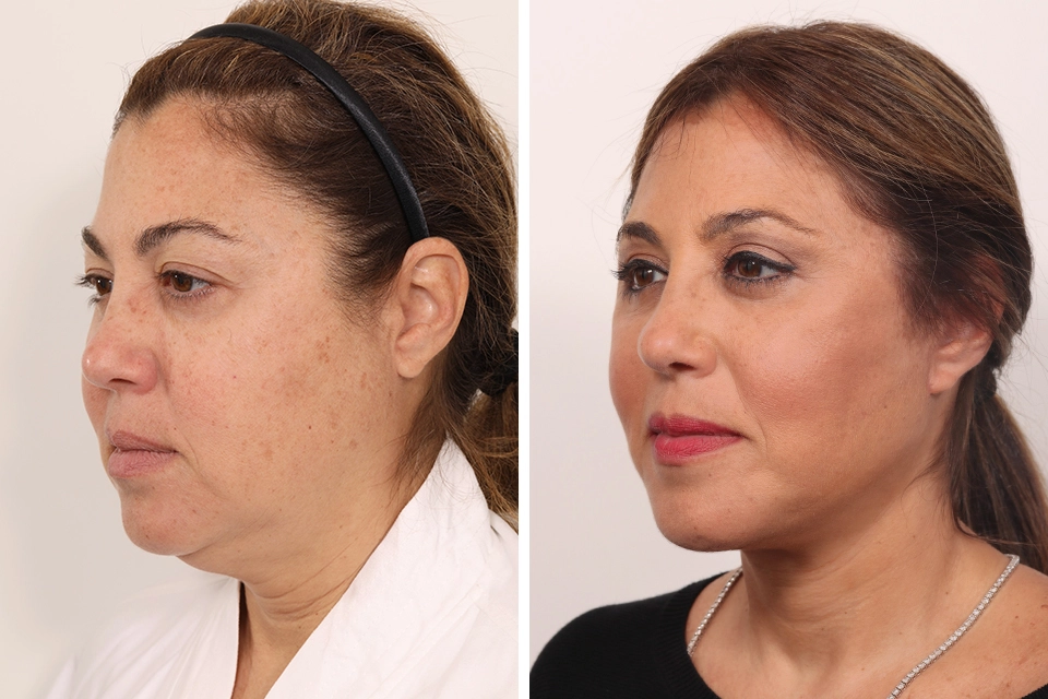 Blepharoplasty case #5634