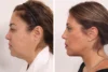 Blepharoplasty case #5634 slider thumbnail