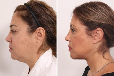 Blepharoplasty case #5634