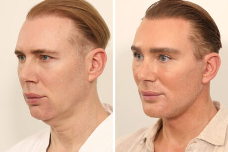 Blepharoplasty case #5574