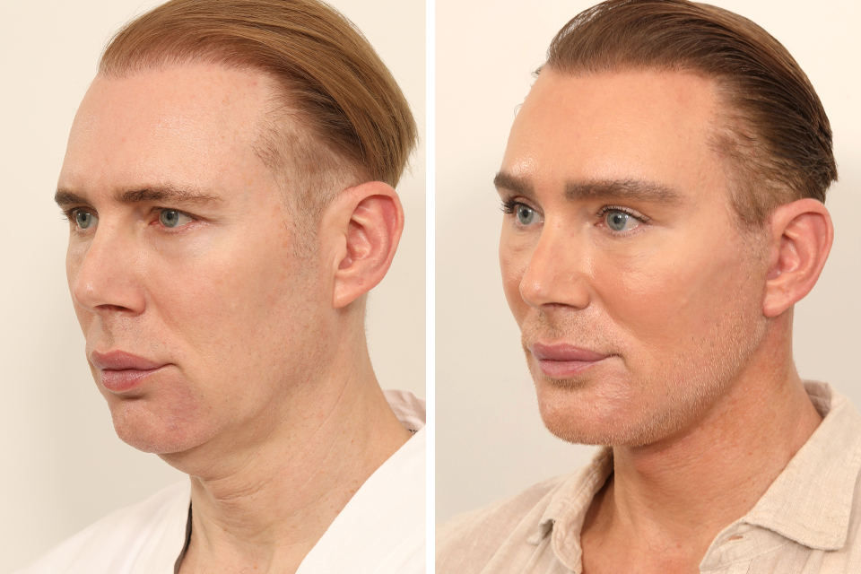 Blepharoplasty case #5574