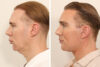 Blepharoplasty case #5574 slider thumbnail
