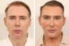 Blepharoplasty case #5574 slider thumbnail